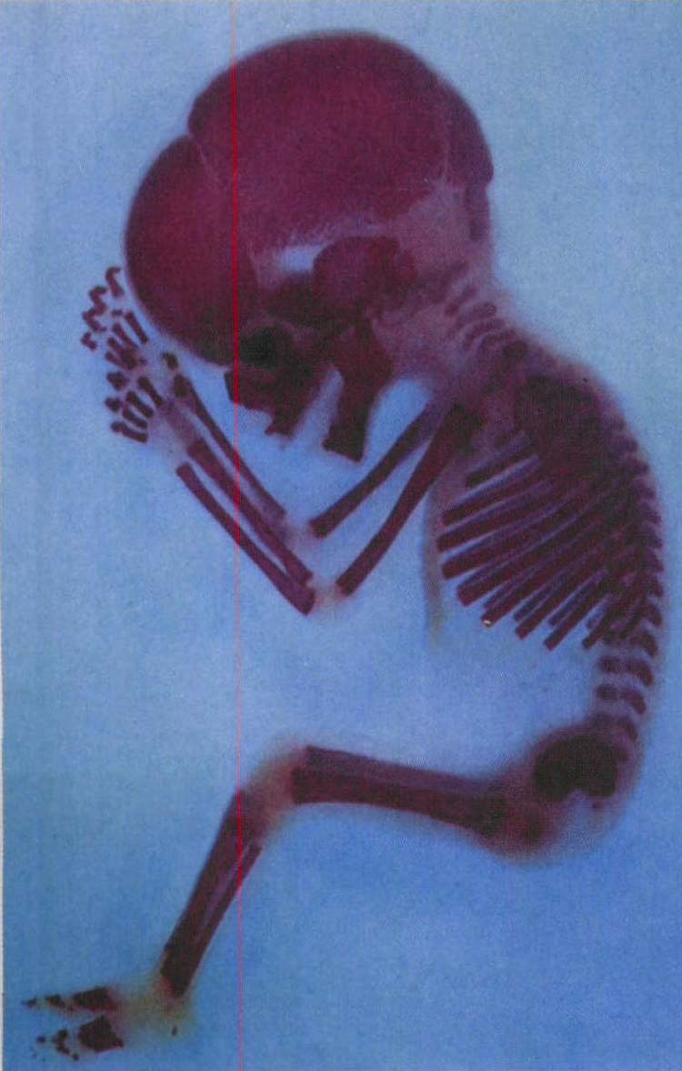图1-9 胎儿骨骼发育(第12周)